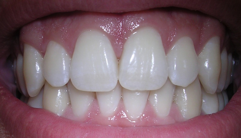 Natürlich weiße Zähne, ganz ohne chemisches Bleaching